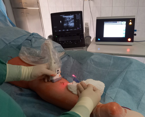 II. chirurgická klinika operuje nejvíce varixů na jižní Moravě