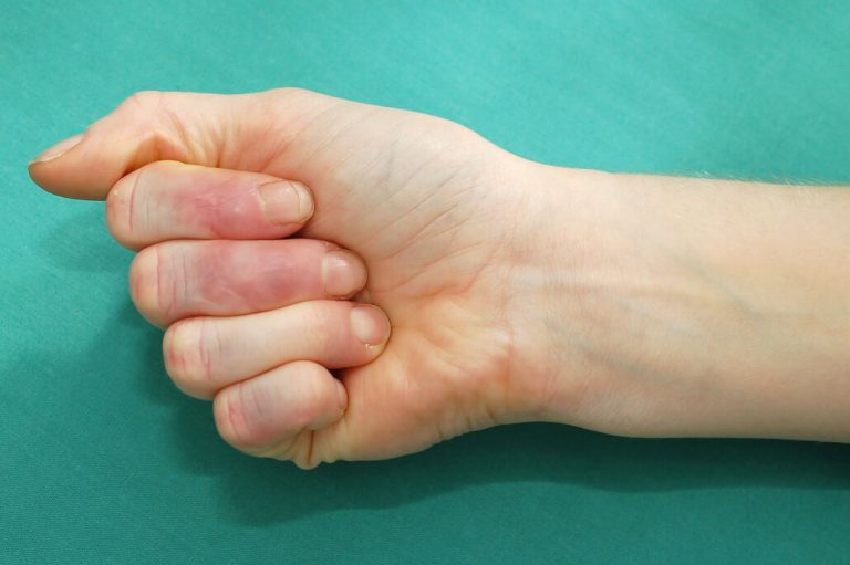 Plastičtí chirurgové v rámci osvětové kampaně radí, jak ošetřit amputovaný prst