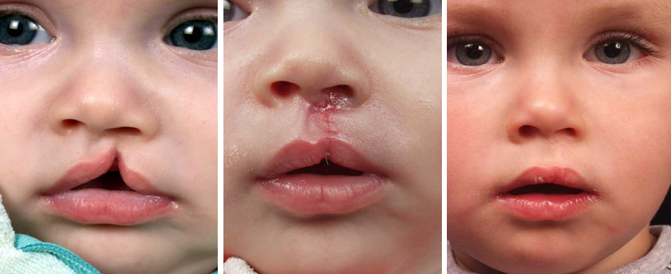 Dítě před a po rekonstrukci rtu.
