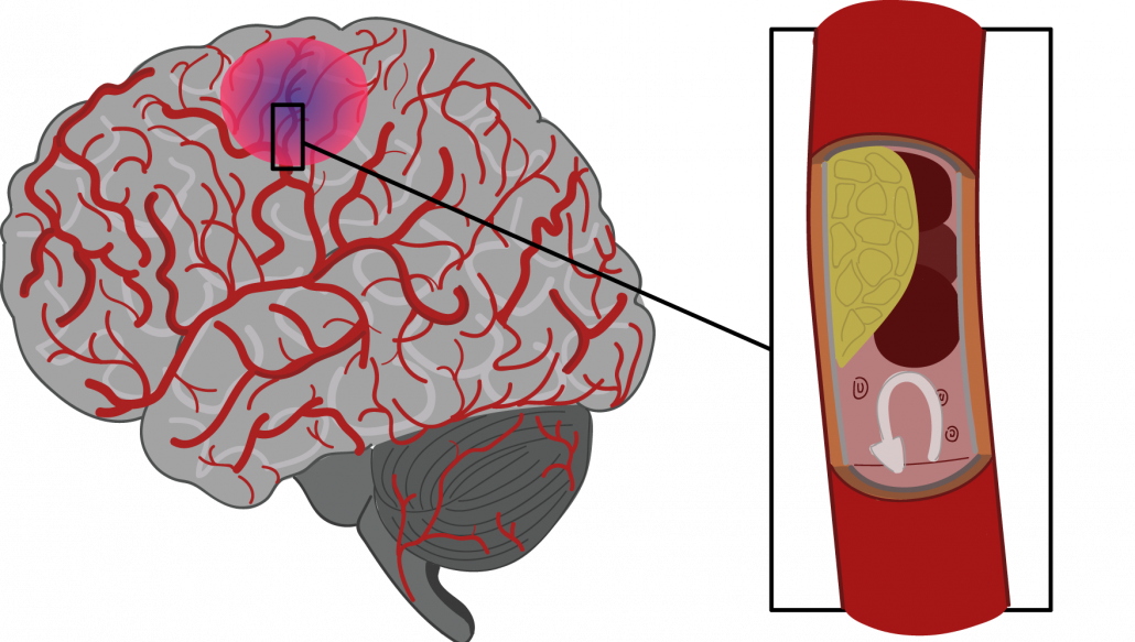 Co způsobuje nedokrvení mozku?