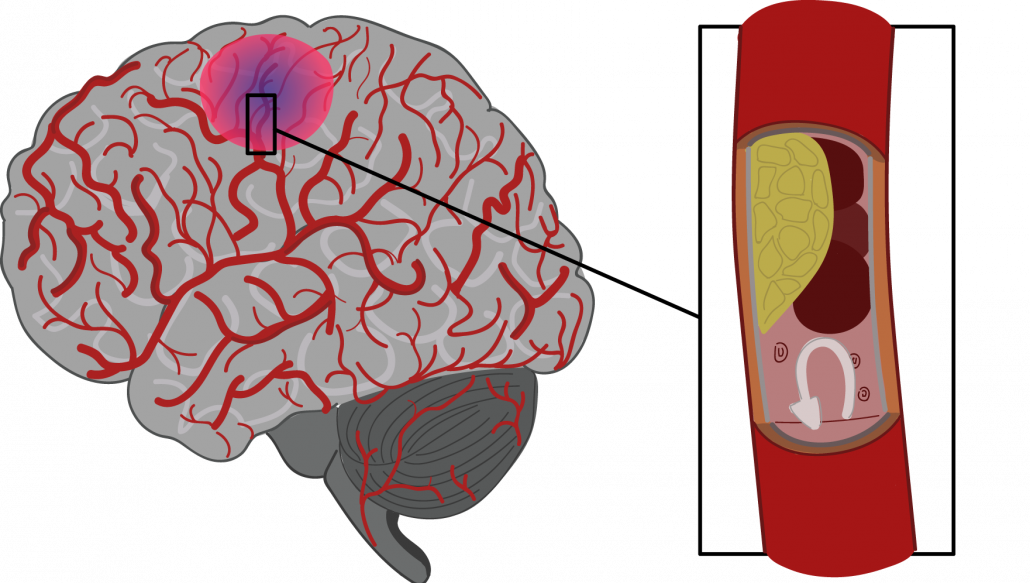 Имеет крови мозга и. Инсульт рисунок. Ишемический инсульт мозга.