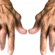 Počet pacientů s revmatoidní artritidou roste